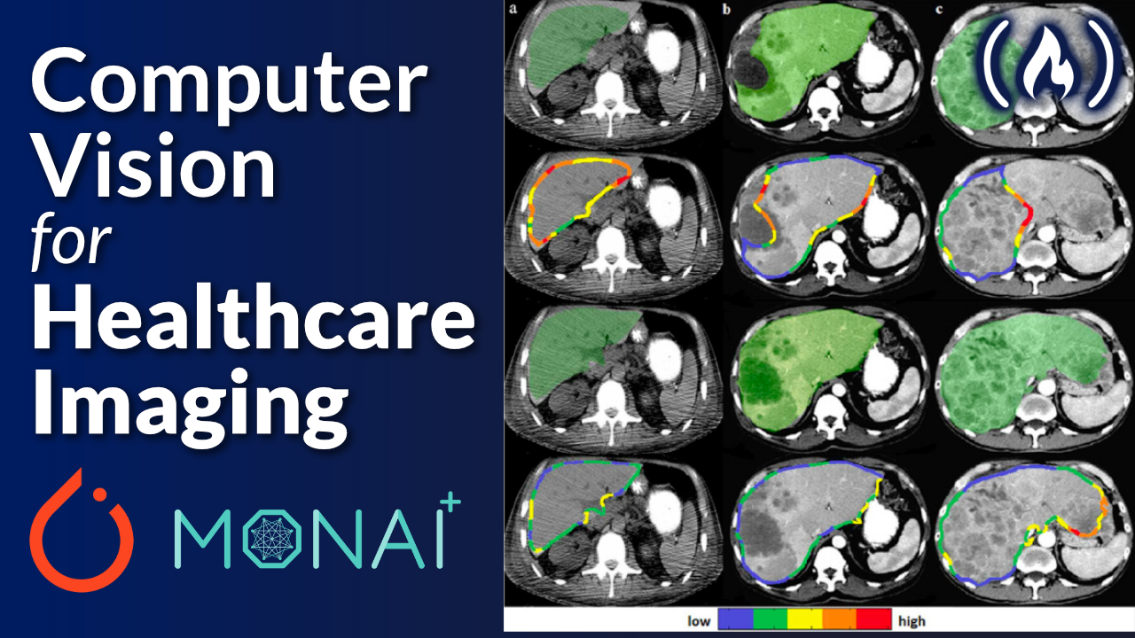 Real-World Machine Learning—PyTorch and Monai for Healthcare Imaging